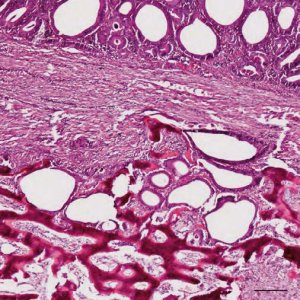 histology-of-an-adenocarcinoma