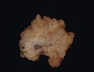 macroscopy-of-a-mandarin-sized-adenocarcinoma