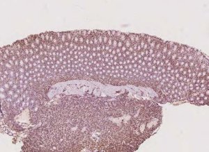 t-cell-lymphoma